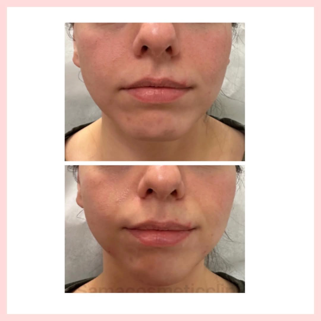 1 cc Chin Filler