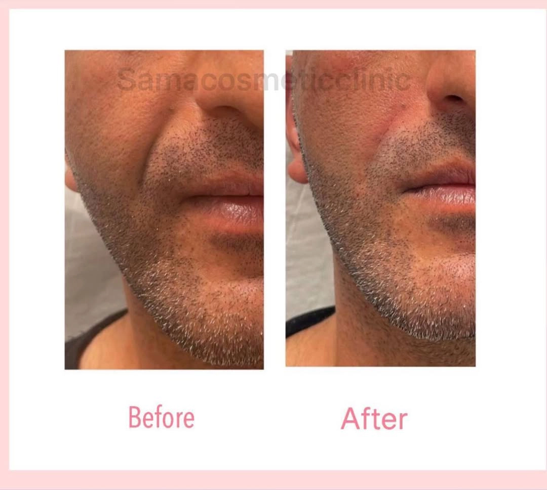 1 cc Teosyal Filler