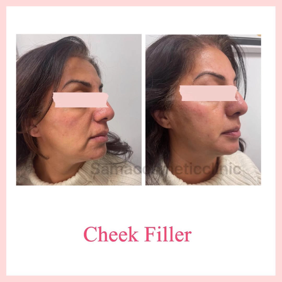 1.5 cc Cheek Filler. 0.5 cc chin filler
