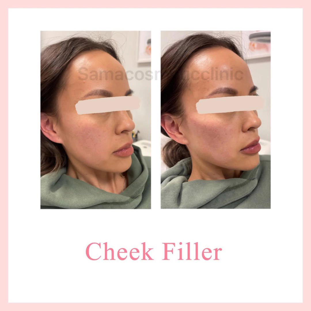 Cheek filler7