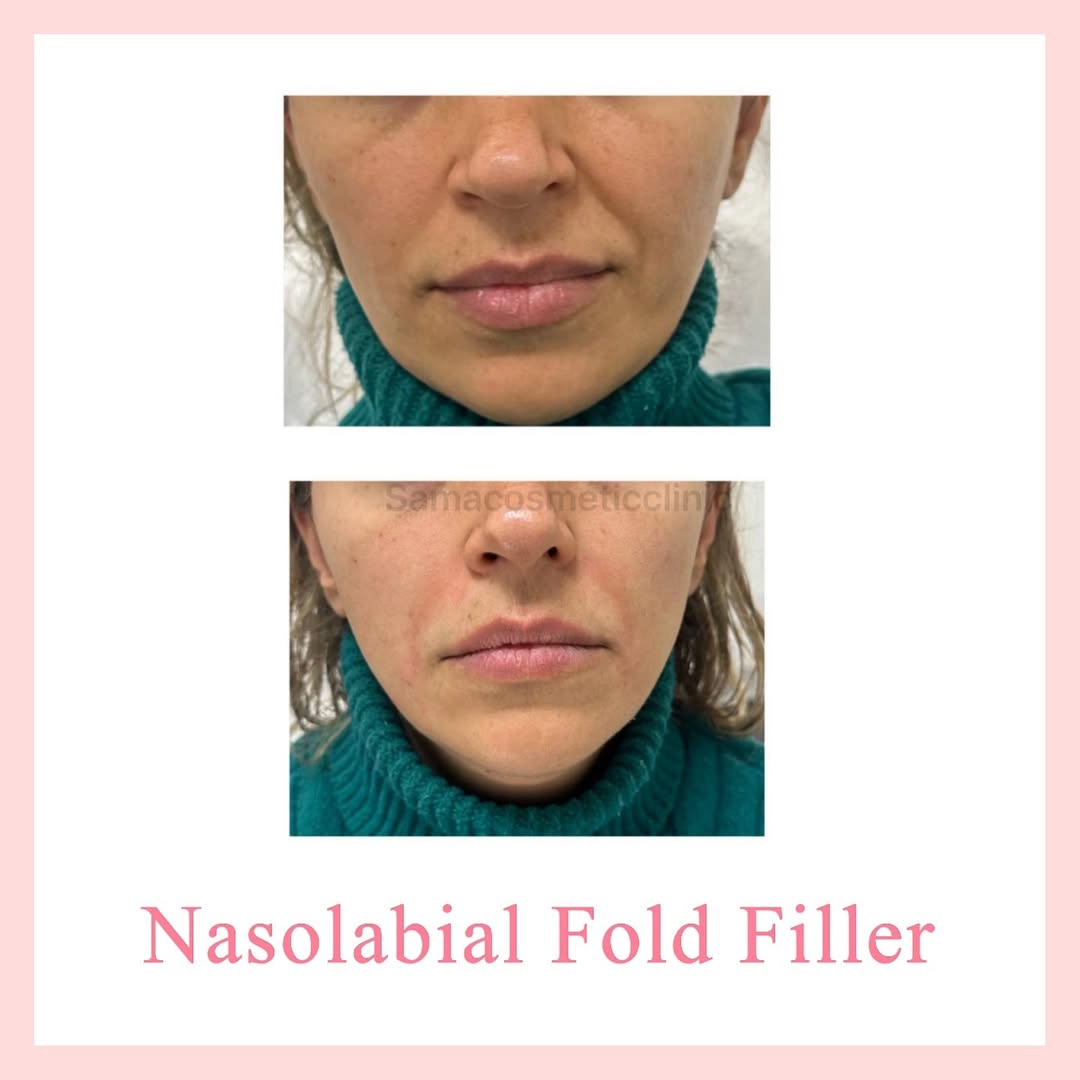 Fold filler