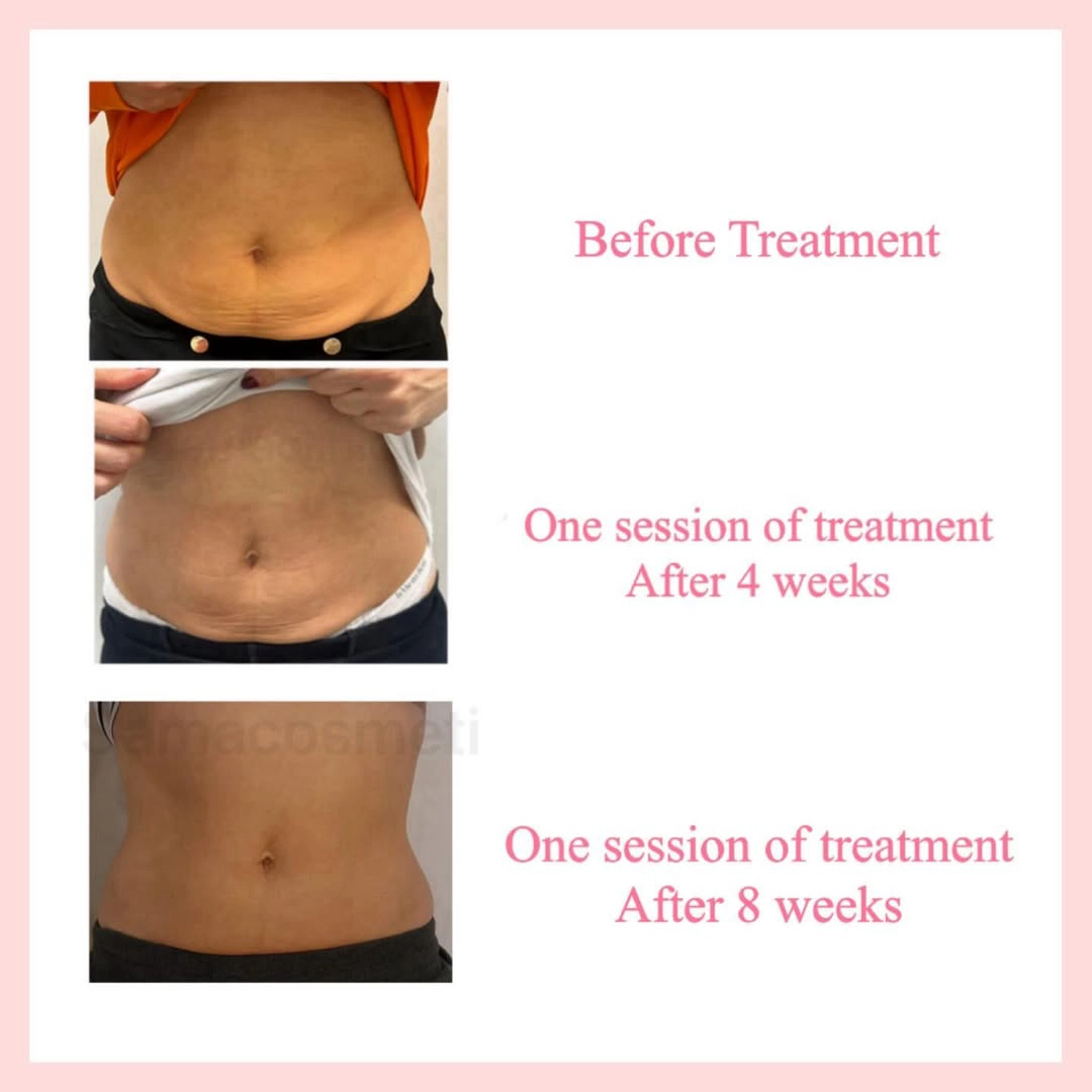 Infini RF microneedling