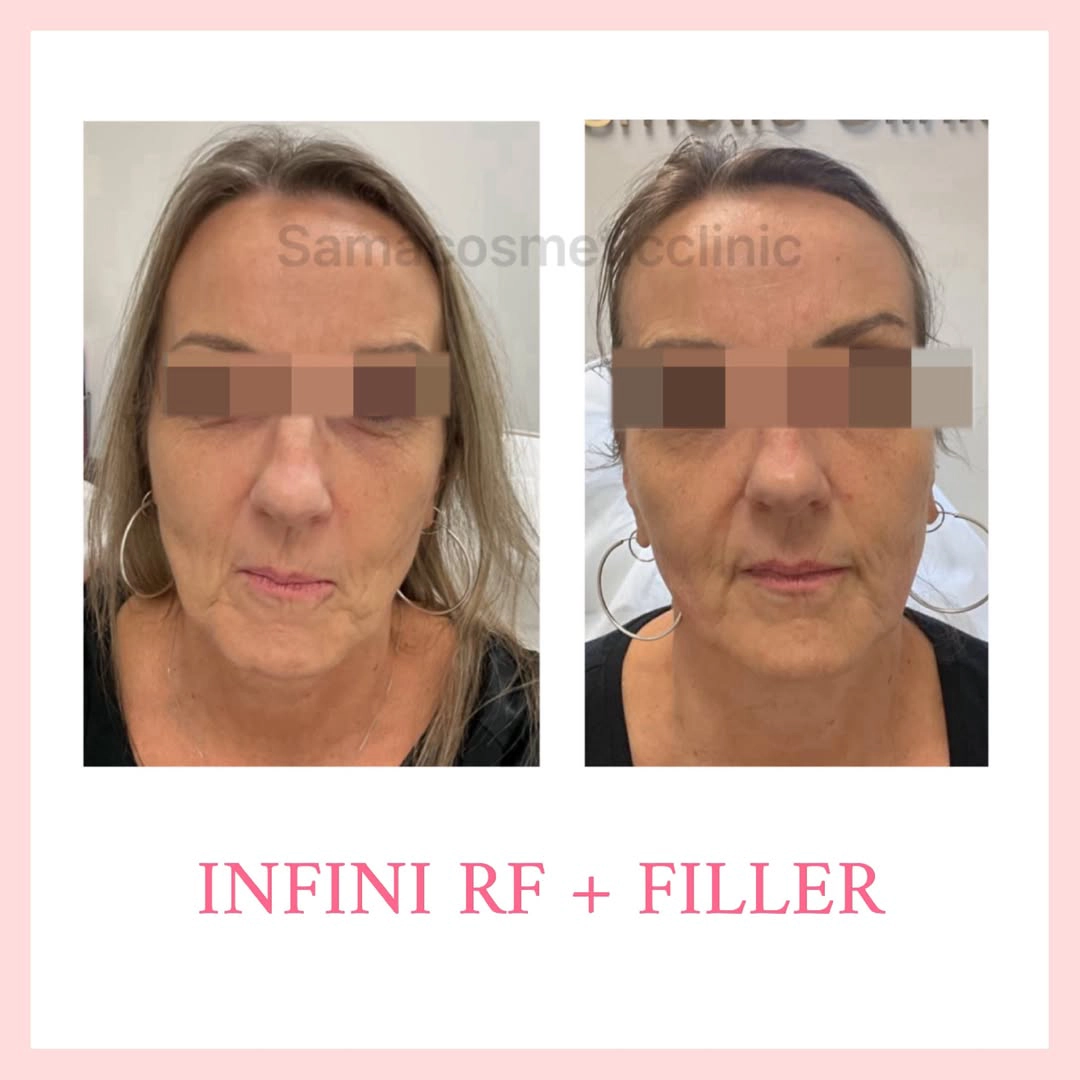 Infini rf va filler