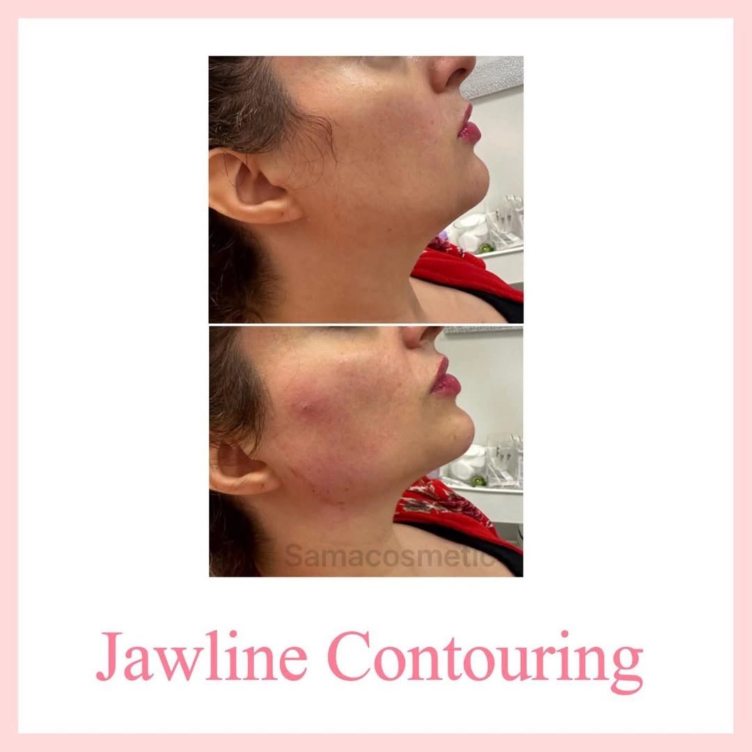 Jawline Contouring