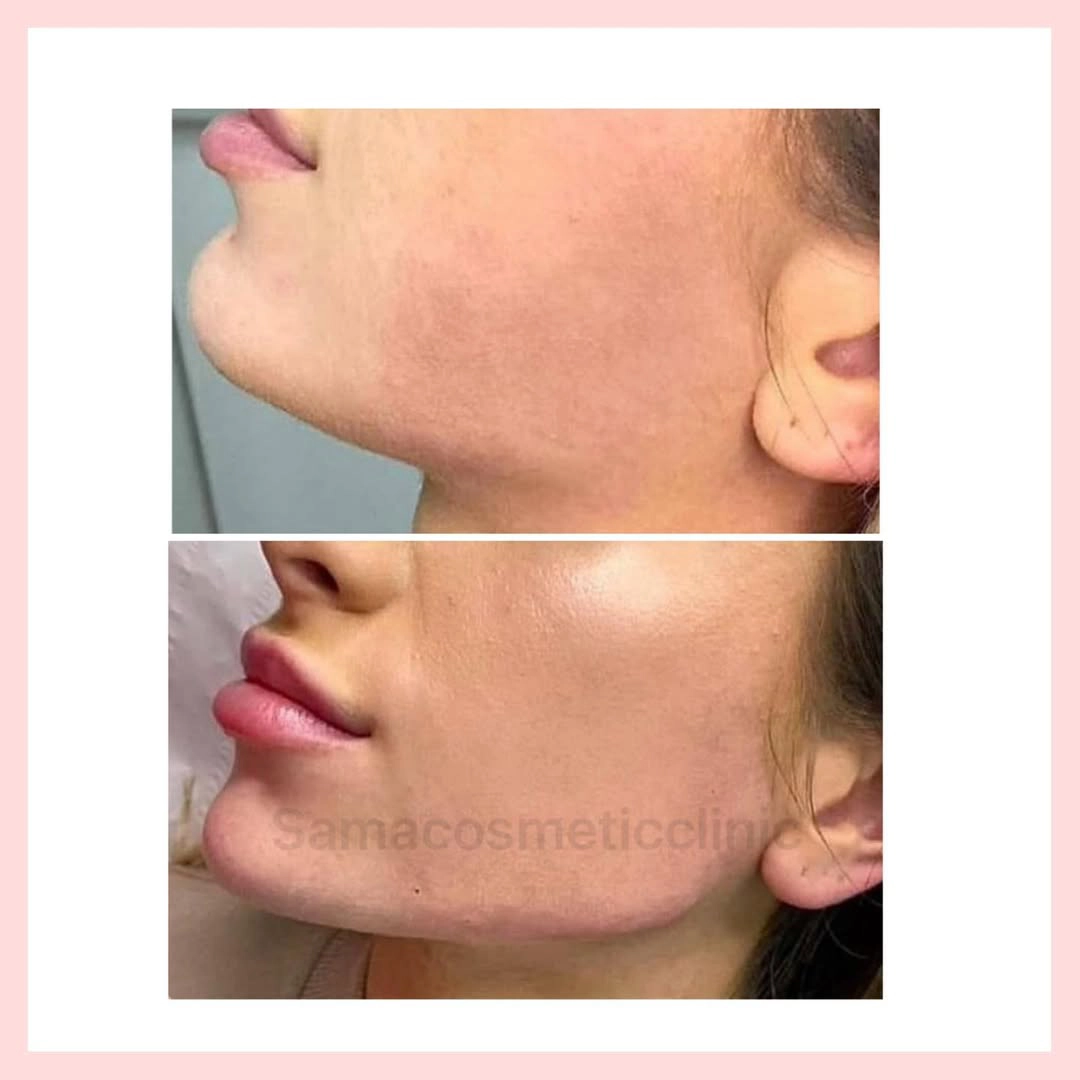 Jawline filler3