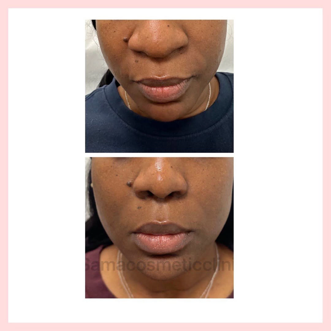 Nose Botox + Chin Filler
