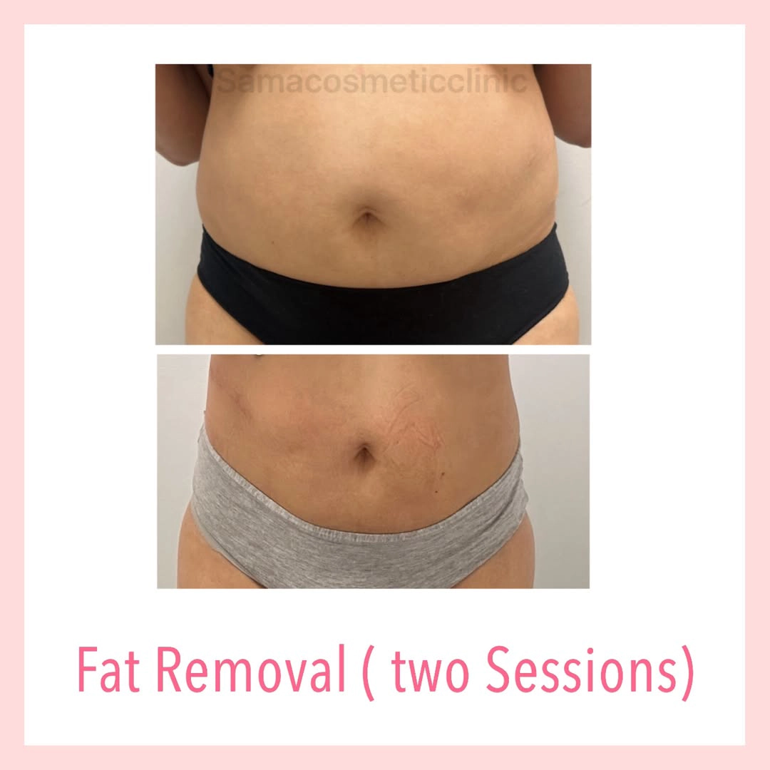 fat removal