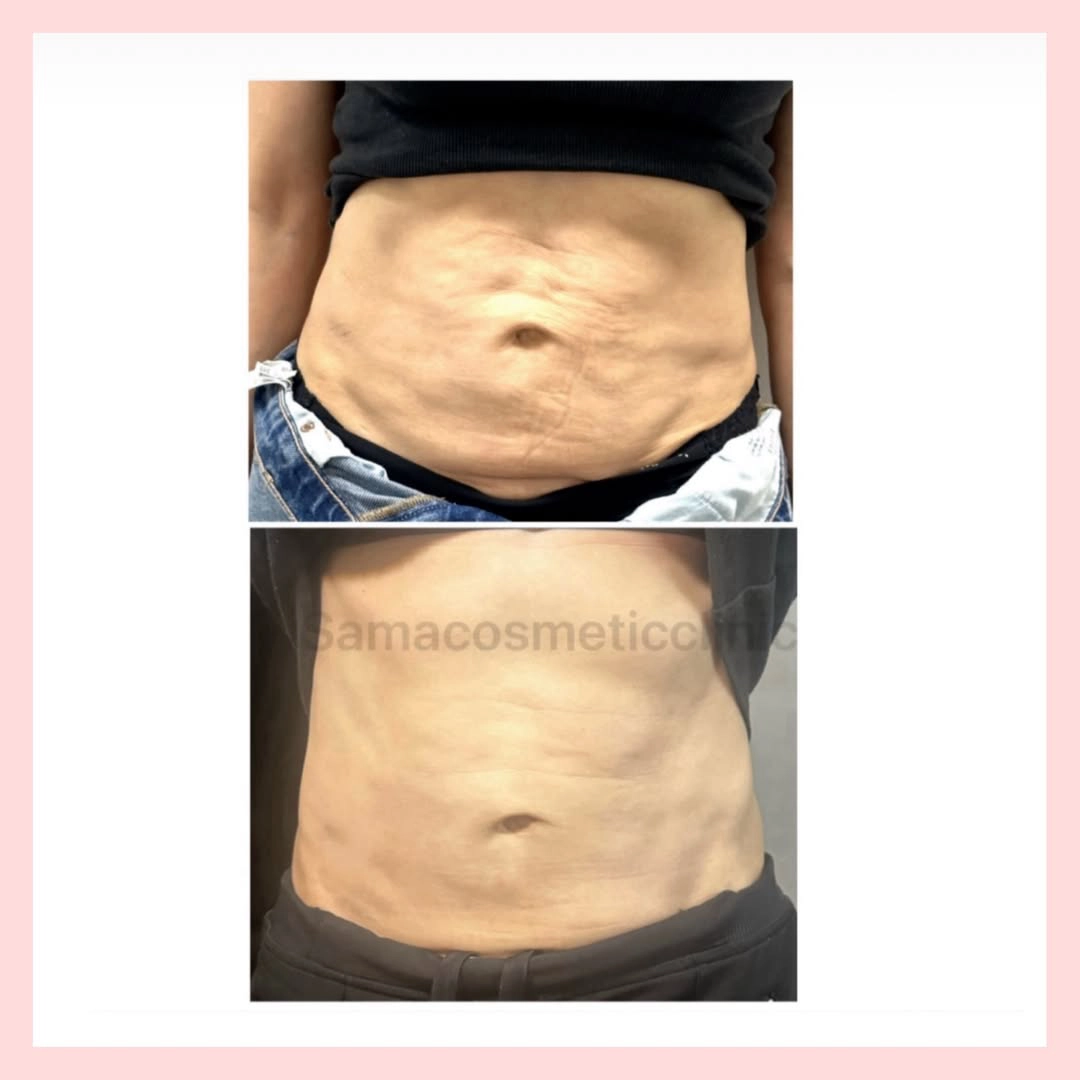 nfinirfmicroneedling